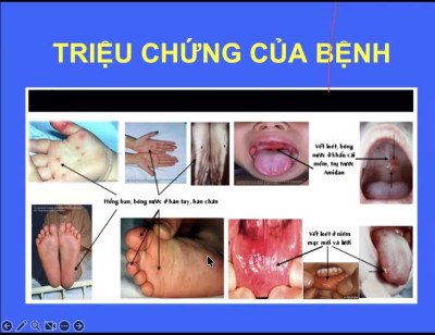 Bàii tuyên truyền Bệnh Tay chân miệng